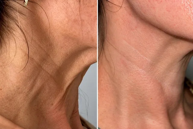 Neck rejuvenation before and after treatment at iBeautify Aesthetics Tunbridge Wells