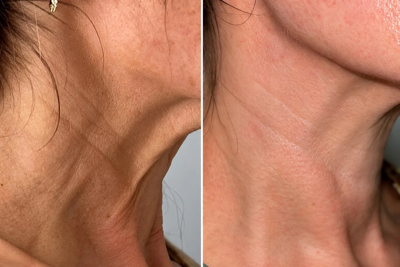 Neck rejuvenation before and after treatment at iBeautify Aesthetics Tunbridge Wells